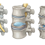 Signs and Symptoms of Degenerative Disc Disease Explained